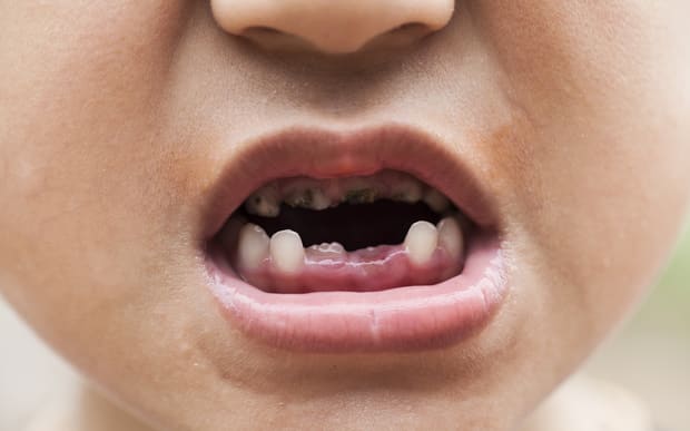 5 Things You Need to Do to Prevent Tooth Decay