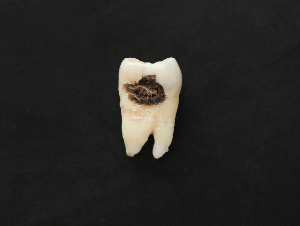 image of tooth with decay and rotting visible