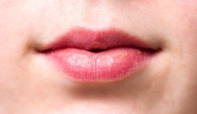 Dry Mouth - Symptoms and Causes